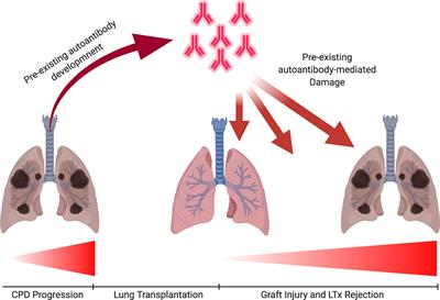 Set Up for Failure: Pre-Existing Autoantibodies in Lung Transplant